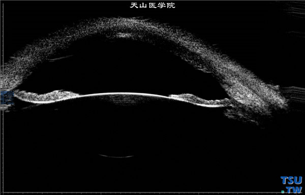 角膜化学伤稳定期，上图同一患者，超声生物显微镜检查，周边虹膜无前粘连，房角开放