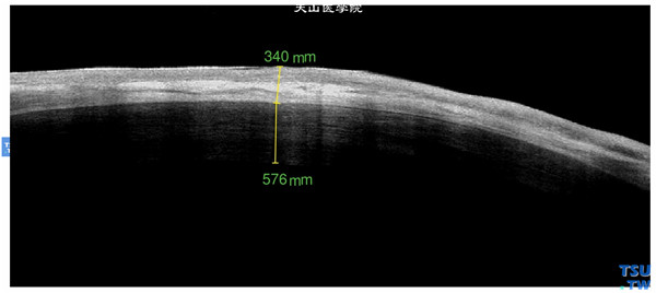 角膜化学伤稳定期，上图同一患者，RTvue OCT检查，显示角膜表面被血管膜性组织覆盖，影像上表现为与正常角膜组织明显的界面，可作为选择手术方式的重要参考依据