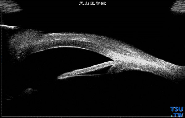 角膜化学伤稳定期，上图同一患者，超声生物显微镜检查