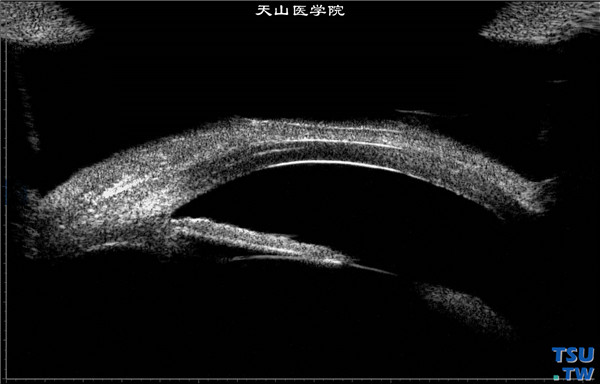 角膜化学伤稳定期，以上两张图片显示，超声生物显微镜检查，周边虹膜无前粘连，房角开放