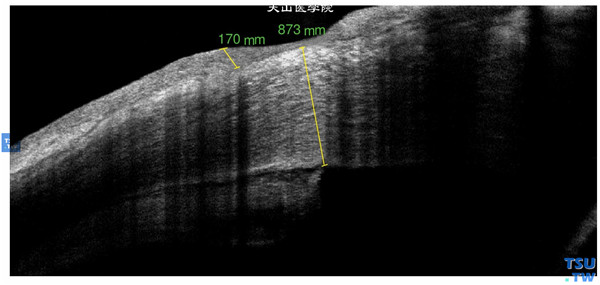 角膜化学伤稳定期，重度，上图同一患者，RTvue OCT检查，可见致密的血管膜性组织的影像