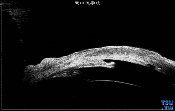 角膜化学伤稳定期，重度，上图同一患者，超声生物显微镜检查，可见虹膜萎缩，周边虹膜前粘连，房角关闭