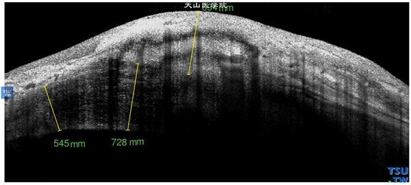 角膜化学伤稳定期，重度，上图同一患者，RTvue OCT检查，可见角膜基质层致密的、密度不均的影像