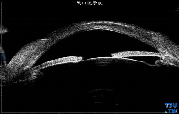 角膜化学伤稳定期，重度，上图同一患者，超声生物显微镜检查，可见颞侧房角开放，鼻侧周边虹膜前粘连，房角开放