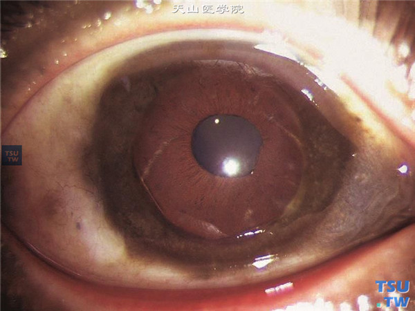 硝酸银灼伤，上图同一患者，因角膜黑色银质沉着行穿透角膜移植术，术后随访15年，角膜植片透明，植床仍有银质沉着