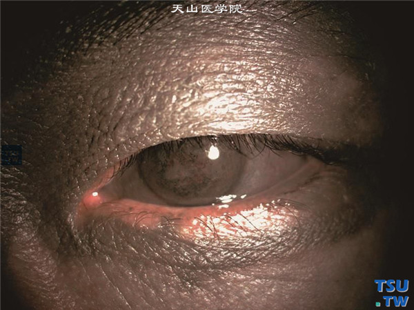 硝酸银灼伤19年，上图同一患者，左眼眼睑皮肤周围也有相同的银质沉着