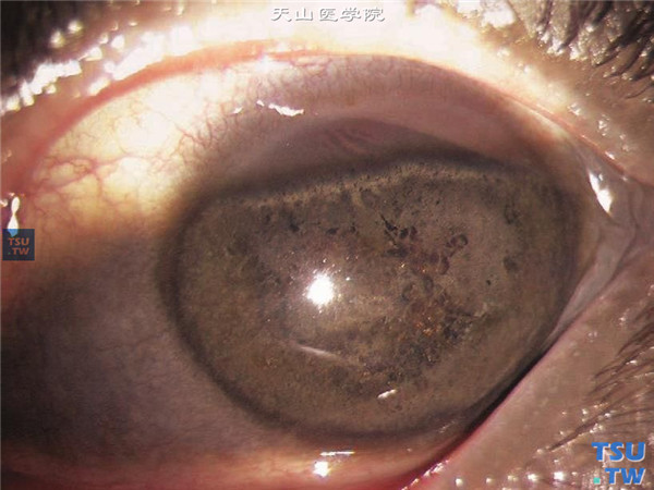硝酸银灼伤，左眼在睑裂部位的角膜和结膜，可见黑色银质沉着，累及角膜深基质层，眼内组织视不清