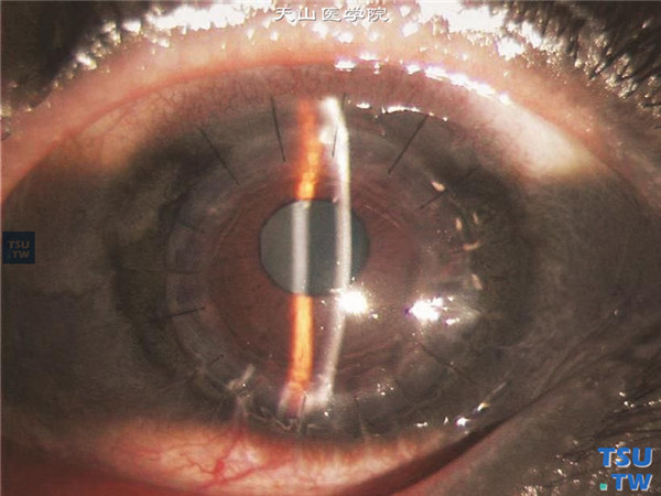 硝酸银灼伤，左眼行穿透角膜移植术，术后随访5个月，角膜植片透明，角膜缘周围银质沉着