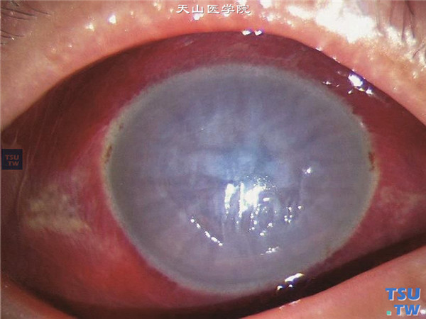  角膜碱化学伤（氰化钾）急性期，中度，角膜基质弥漫性水肿混浊，角膜后弹力层皱褶，内皮损伤呈龟裂状