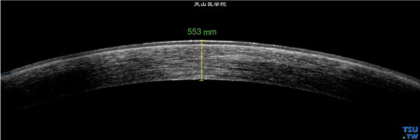 角膜碱化学伤（氰化钾）急性期，上图同一患者，RTvue OCT检查，显示角膜浅基质层有轻度混浊的影像，角膜厚度正常，影像的密度均一，上皮层和内皮层完整