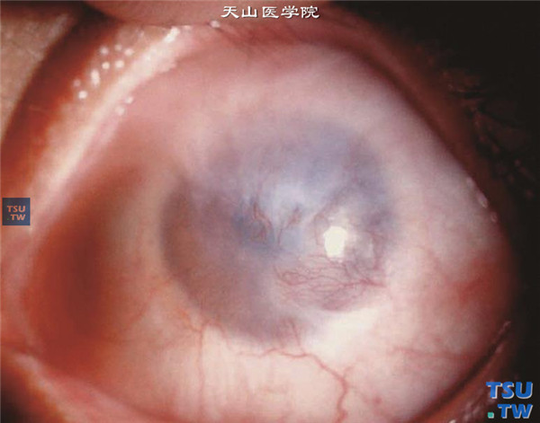 角膜酸化学伤稳定期，中度，3/4圆周角膜缘组织瘢痕化，角膜覆盖有血管膜，瞳孔和部分虹膜隐约可见，眼压正常