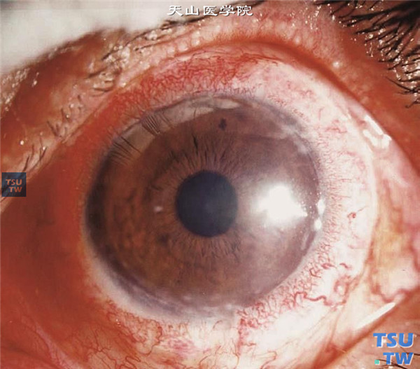 角膜酸化学伤稳定期，上图同一患者，行角膜血管膜切除联合角膜缘组织移植术，术后随访5个月，可见移植的供体角膜缘组织存活，眼表稳定