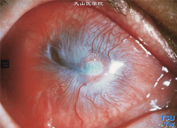 角膜碱化学伤稳定期，重度，可见全周角膜缘纤维化，血管膜覆盖全角膜，眼压正常