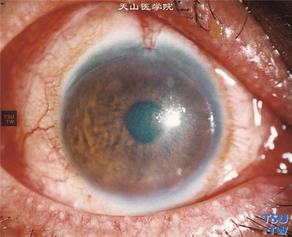 角膜碱化学伤稳定期，重度，上图同一患者，行角膜血管膜切除联合同种异体角膜缘组织移植术，术后随访20个月，可见移植的环形角膜缘组织存活，眼表稳定
