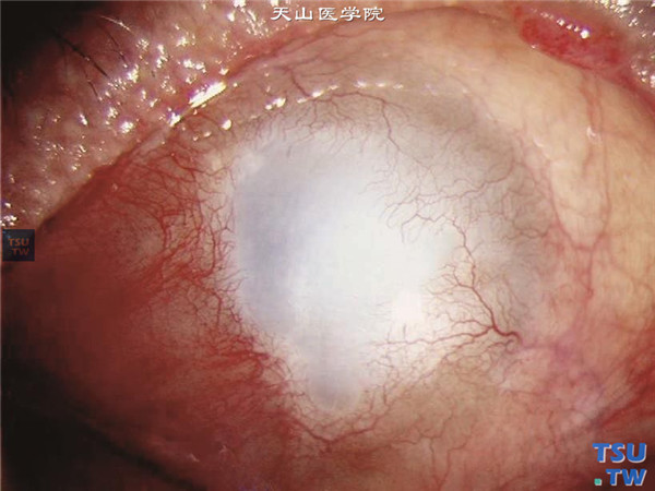 角膜碱化学伤稳定期，重度，角膜全部被血管膜性组织覆盖，眼内结构视不清