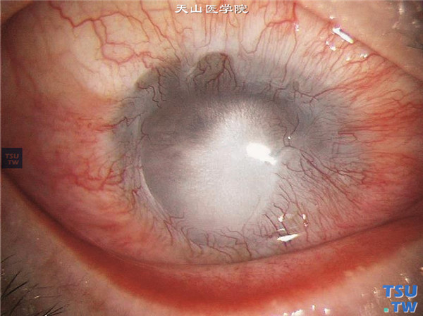 角膜碱化学伤稳定期，角膜被血管膜性组织覆盖，视力手动/20cm