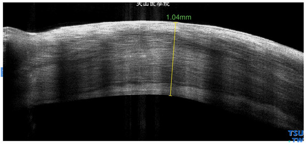 角膜碱化学伤稳定期，上图同一患者，RTvue OCT 检查，可见角膜明显增厚，角膜基质层呈现密度不均的影像