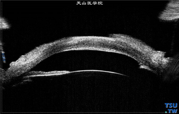 角膜碱化学伤稳定期，上图同一患者，超声生物显微镜检查，可见颞侧房角变窄，鼻侧虹膜萎缩，前粘连，房角关闭