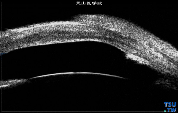 角膜碱化学伤稳定期，超声生物显微镜检查，显示虹膜萎缩，前粘连，房角关闭