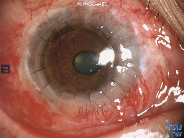角膜碱化学伤稳定期，上图同一患者，行穿透角膜移植联合角膜缘组织移植术，术后随访6个月，角膜植片透明，视力0.2