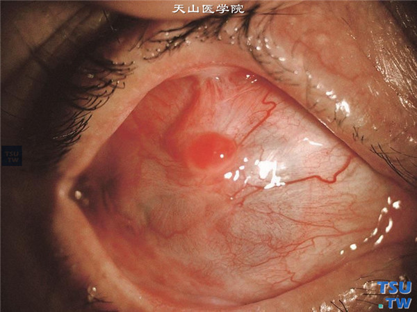角膜化学伤（酸性、碱性物质进入眼睛）3期症状图解