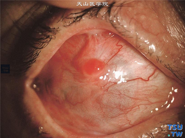 角膜碱化学伤稳定期，角膜被血管膜性组织覆盖，隐约可见角膜缘的轮廓，病变角膜表面有息肉生长，上方睑球粘连