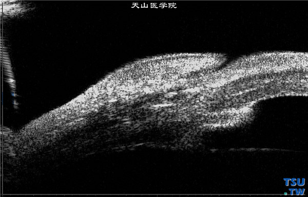 角膜碱化学伤稳定期，上图同一患者，超声生物显微镜检查，可见角膜明显混浊增厚，虹膜萎缩，前粘连，房角关闭