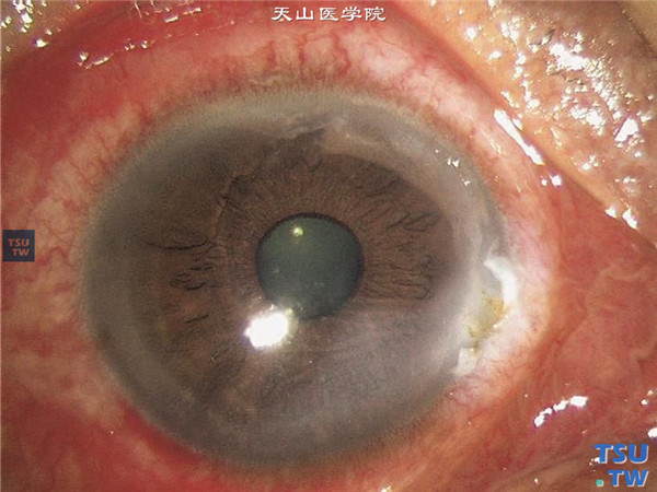 角膜热烧伤（眼睛被开水/油/铁/铝/钢烫伤）症状图解