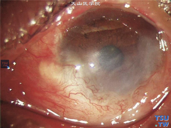 铝水灼伤，上图同一患者，先后两次行羊膜移植术，术后随访2个月，可见角膜瘢痕形成，结膜缺血改善，新生血管长入