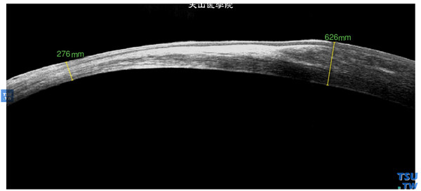 钢水烫伤，上图同一患者，RTvue OCT检查，可见角膜厚薄不均，上方角膜最薄处仅有276mm