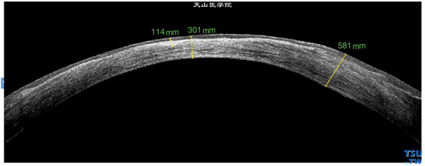 患者2年前行LASIK术，皮内生，上图同一患者，RTvue OCT检查，显示手术区角膜明显变薄，角膜基质瘢痕化，呈高密度致密影像，上皮层和内皮层尚完整