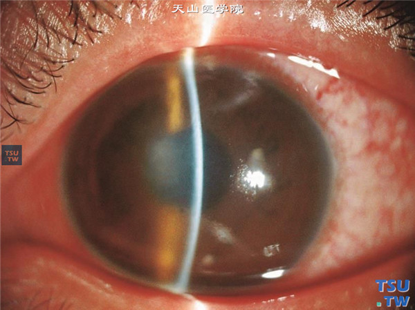眼角膜生物损伤（昆虫毒液入眼）症状图解