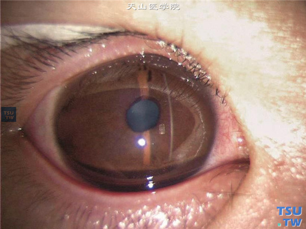 大角膜，角膜直径14mm，眼压正常，角膜透明，无自觉症状