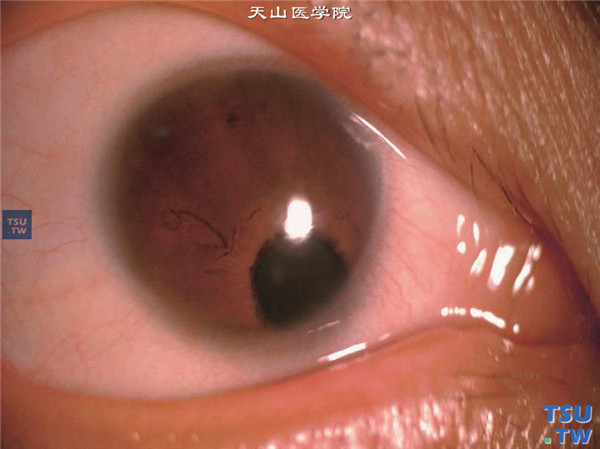 小角膜，角膜直径为8.5mm，伴有先天性虹膜缺损和部分脉络膜缺损