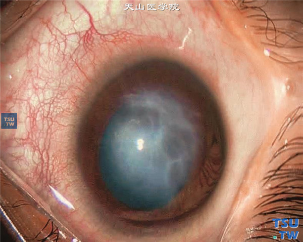 角膜先天异常：球形角膜症状及治疗图解