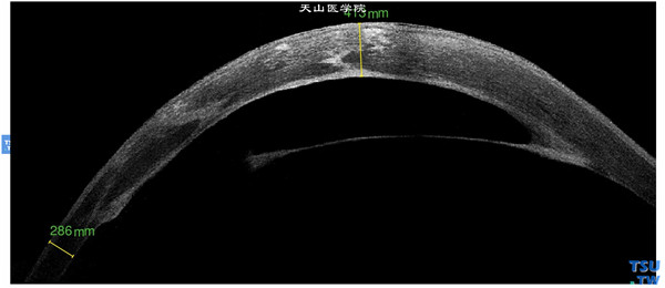球形角膜，同一患儿，右眼Visante OCT检查，中央区角膜水肿混浊，但厚度仅为413mm，周边角膜厚度为295mm，角膜后弹力层剥离