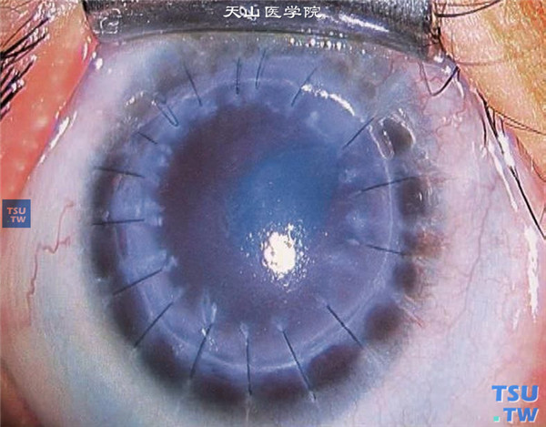 球形角膜，同一患儿，行穿透角膜移植术，术后随访8个月，角膜植片尚透明