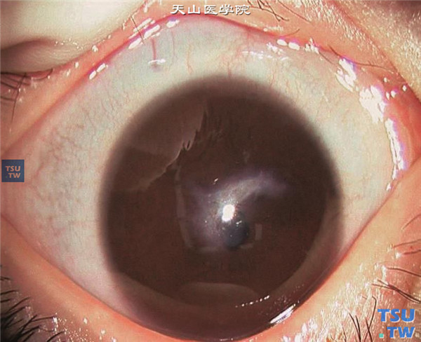 球形角膜，同一患儿，左眼中央区角膜陈旧性瘢痕，虹膜部分前粘连，角膜曲率检查为53.20D/56.90D