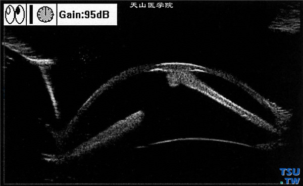 球形角膜，超声生物显微镜检查