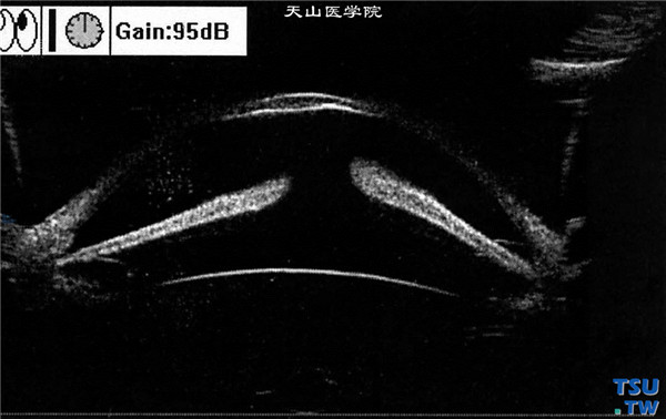 以上两张图片，左眼超声生物显微镜检查，可见角膜明显变薄扩张，部分虹膜前粘连，房角极窄，部分关闭