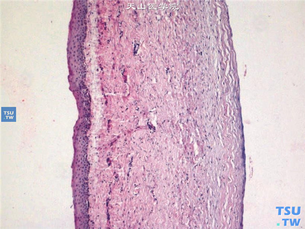 巩膜化角膜，组织病理学检查 HE ×100