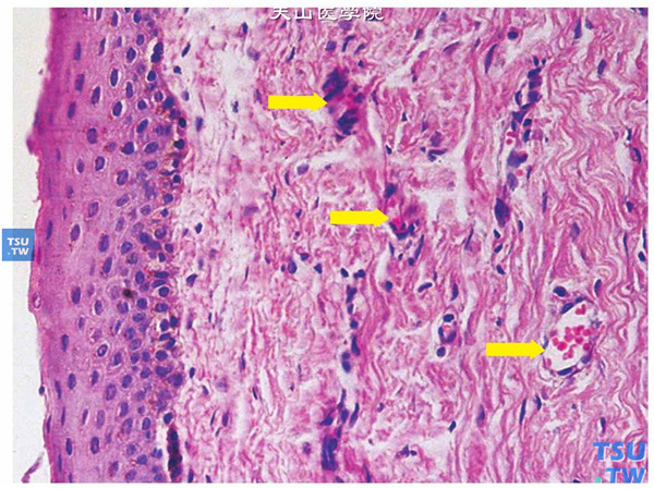 以上两张图片显示，病变角膜片行组织病理学检查，HE染色可见角膜基质内纤维结缔组织，胶原纤维排列紊乱，角膜内较多血管生长（箭头标示处） HE ×400