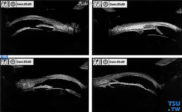 先天性角膜混浊，左眼超声生物显微镜检查，可见虹膜萎缩，部分虹膜前粘连和后粘连，房角关闭，角膜厚薄不均