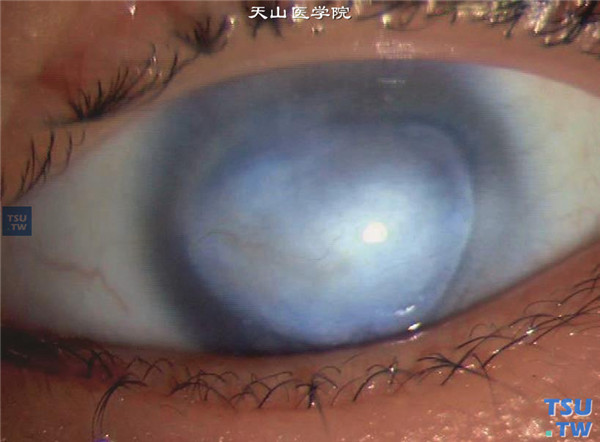 先天性角膜混浊，上述患儿，右眼先天性角膜混浊，血管较左眼少，周边透明带明显