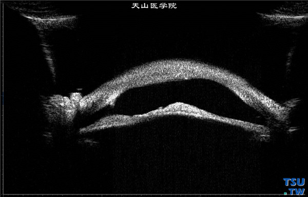 先天性角膜混浊，右眼超声生物显微镜检查，可见角膜混浊，厚薄不均，虹膜萎缩，瞳孔膜闭，房角开放