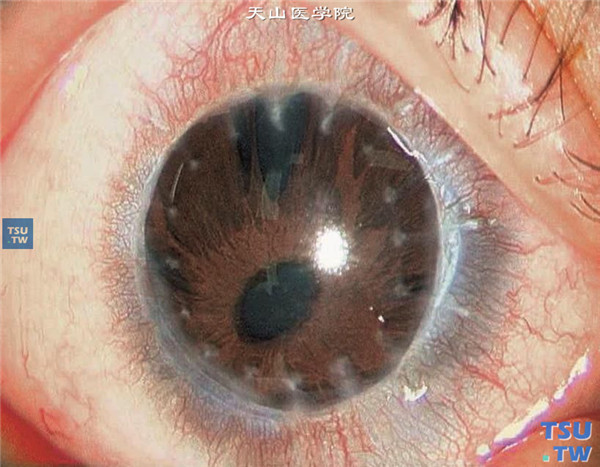 先天性角膜混浊，右眼行穿透角膜移植术，术后随访12个月，角膜植片透明