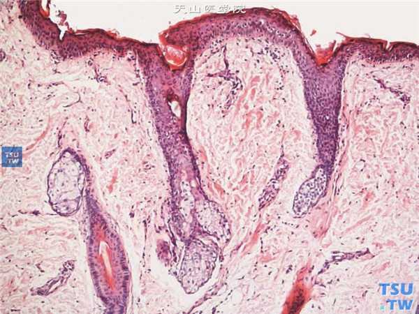 HE×200 以上两张图片显示角膜皮样瘤，术中获取病变组织行组织病理学检查，HE染色可见角膜表层为复层鳞状上皮覆盖，鳞状上皮下有大量纤维结缔组织增生及血管，并有毛囊和皮脂腺等皮肤附件结构
