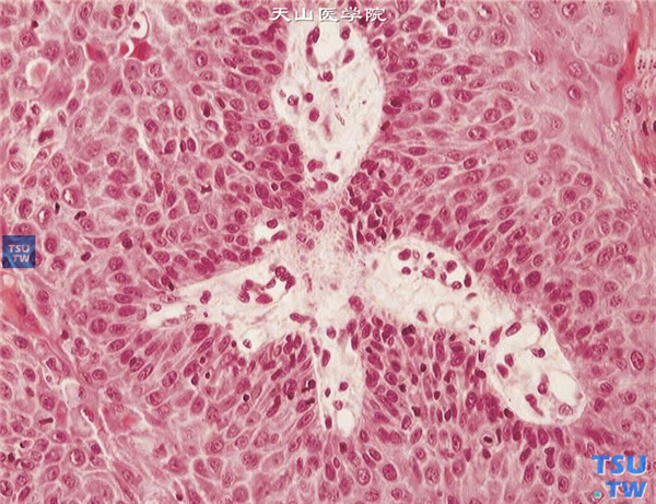 HE×200,以上两张图片显示上述患者，术中获取病变组织行组织病理学检查，HE染色显示瘤细胞呈乳头状增生，可见纤维血管轴心，瘤细胞核增大，核仁明显