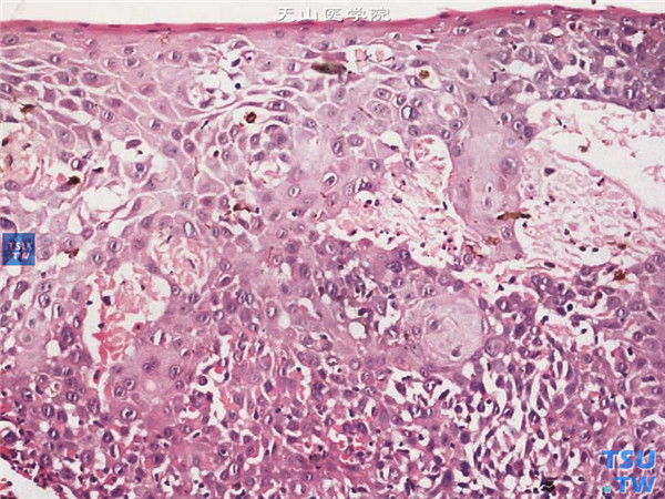 角膜鳞状上皮细胞癌，HE ×200