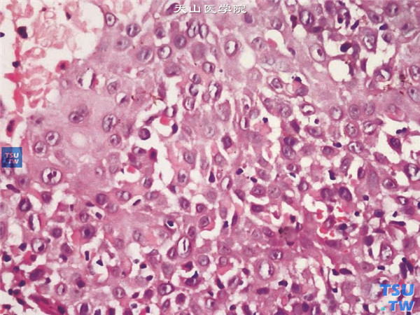 HE×400，上述角膜鳞状上皮细胞癌患者，术中获取病变组织行组织病理学检查，HE染色可见瘤细胞大小不等，细胞核大染色深，核仁明显，有异型
